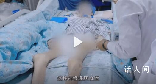 女孩為愛減肥去世:體重24.8公斤