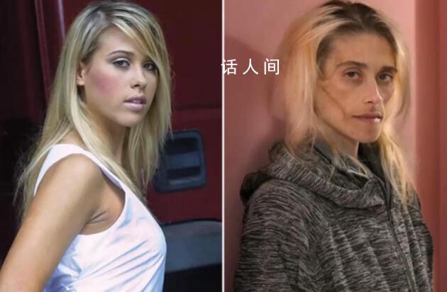 35歲模特患厭食癥去世時僅23公斤 牙齒也掉光了