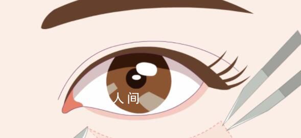 女子3千割眼袋3個月眼睛閉不合 割眼袋有哪些風險