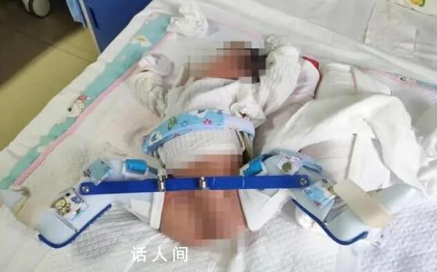 家屬稱剖宮產時孩子大腿被掰骨折 卻不告知家屬