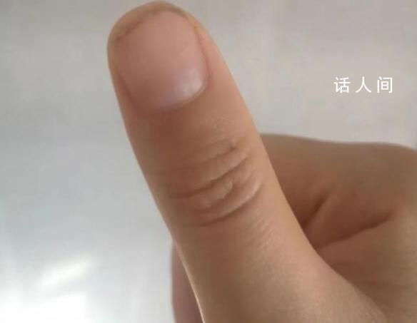 荔枝季致廣東人拇指成黑色 廣東人又實現(xiàn)了荔枝自由