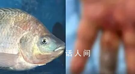男子被魚刺刺傷致手指壞死被截除 目前該男子身體狀況已經(jīng)好轉(zhuǎn)
