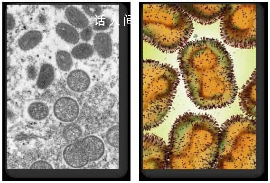 6月內地新增106例猴痘確診病例 猴痘癥狀如何怎么預防