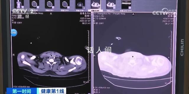 36歲男子吹空調住進ICU 如何預防空調病