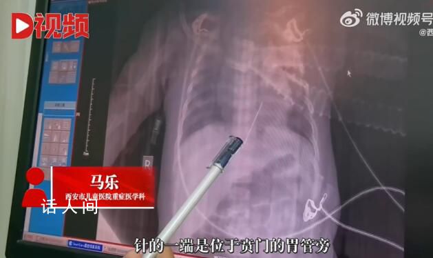 女嬰心臟扎進一根4厘米繡花針 這確實挺罕見的