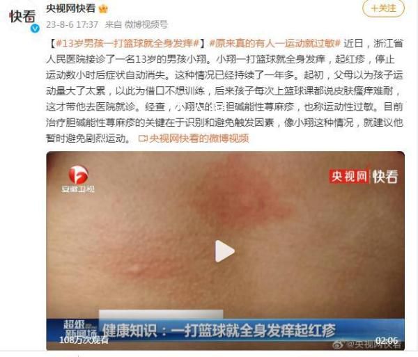 13歲男孩一打籃球就全身發(fā)癢 停止運動數(shù)小時后癥狀自動消失