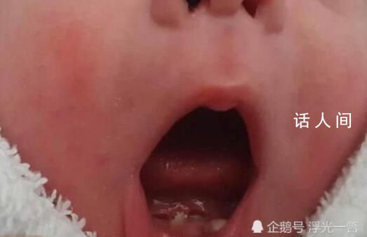 早產(chǎn)兒出生罕見長2顆牙先后被拔掉 驚呆了18歲的新手媽媽和接生醫(yī)生
