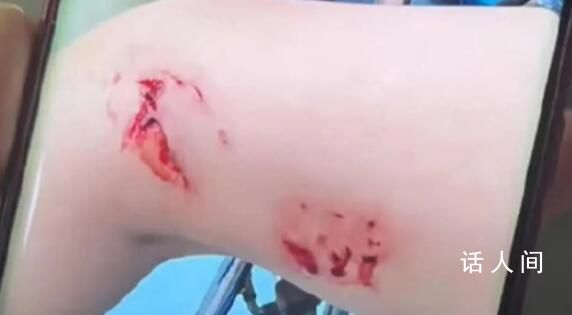 游客被不明魚類咬傷 救援人員發(fā)聲