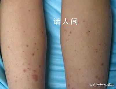 女子稱熬夜致免疫力低下確診紫癜 好在發現及時對身體沒有造成太大損傷