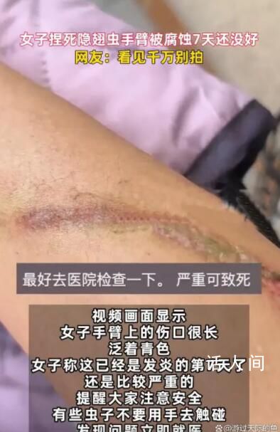 女子捏死隱翅蟲手臂被腐蝕7天還沒好 傷口很長泛著青色