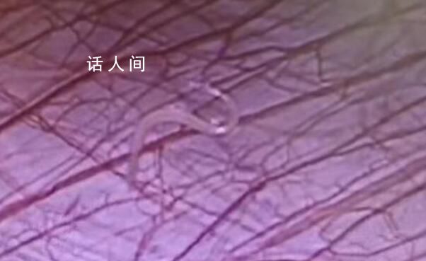 女孩外地求醫 切開闌尾有蟲子游出