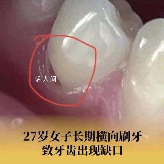 27歲女子長期橫向刷牙致牙齒缺損 什么是橫向刷牙的危害