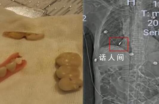 老人術后體內發現5顆牙和牙套 這樣的離奇情況你聽說嗎