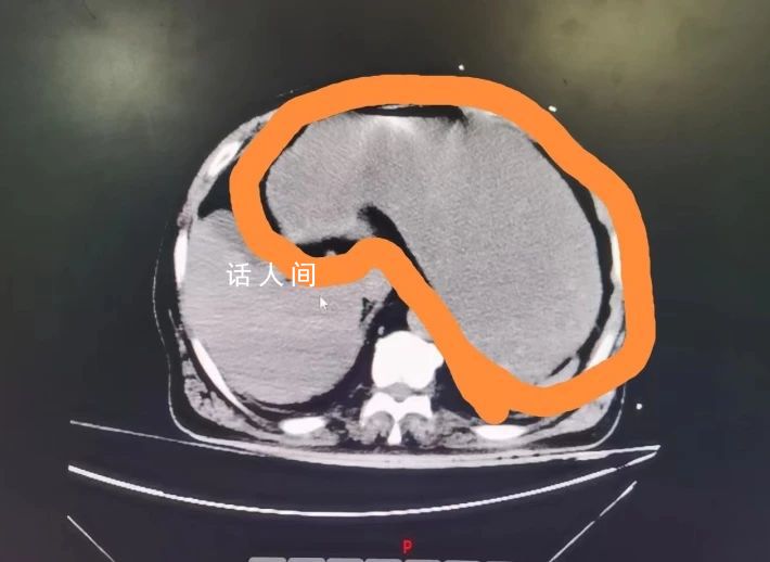 80歲老人胃被未消化食物撐大2倍 做胃鏡麻醉后出現誤吸被送至搶救