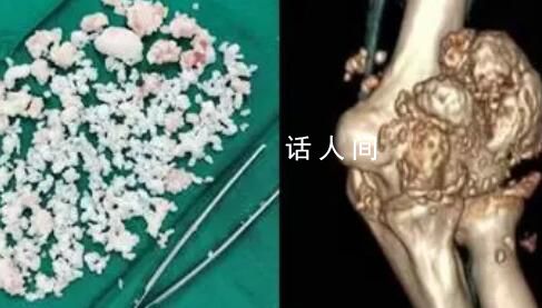 小伙熬夜打游戲關節長千顆白色顆粒 被診斷為滑膜軟骨瘤病