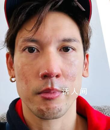 港星關智斌面部手部二級燒傷 好在及時就醫目前已經全部康復