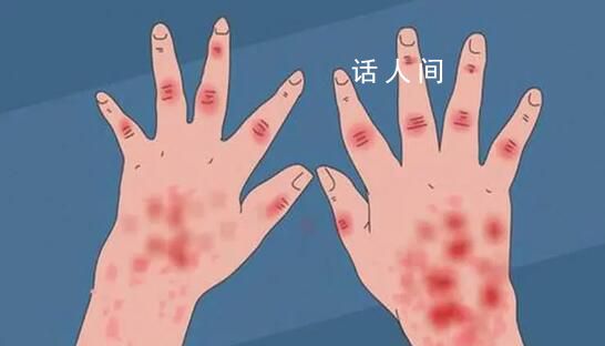 21歲男子發燒后被診斷為紅斑狼瘡 女性發病率是男性的十倍