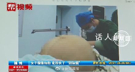 23歲女子腹脹如鼓取出42斤腫瘤 比懷足月雙胞胎的孕婦肚子還要大