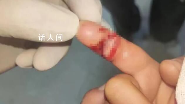 幼童在游樂園手指被夾傷 園方回應