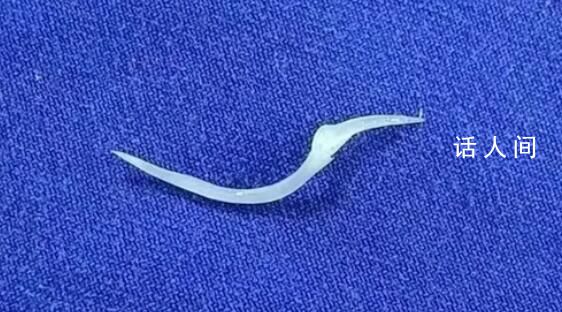 小伙魚刺卡喉強(qiáng)行咽下進(jìn)ICU 不小心咽了魚刺怎么辦