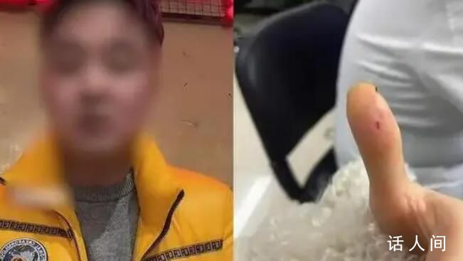 顧客被筷子毛刺扎手治療花1.7萬 醫院回應：未接到任何有關方異議