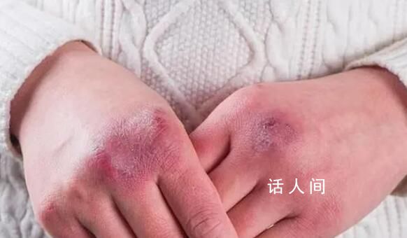 今冬最大寒潮來襲 凍傷記得掛燒傷科