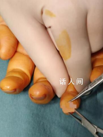女子指尖藏瘤 手指莫名劇痛10年