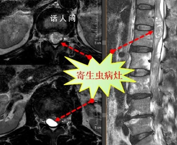 男子吞蛇膽喝蛇藥15年后發病 生吃蛇染寄生蟲